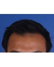 After Hair Transplant &nbsp;2 Sessions (Areas)